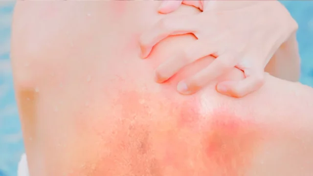 Treating Red Skin & Rash Post-Shower with Well Water